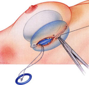 breast-implant